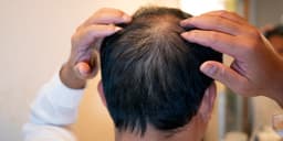 Biotech Company Focused on Hair Loss Sees Stock IPO Surge Despite Lack of Revenue.