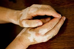 an image of Teva (TEVA) and Royalty Pharma (RPRX) Announce $500M Funding Agreement for TEV-'408 Development