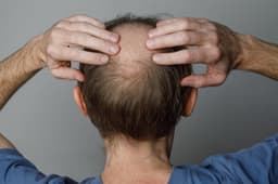 an image of Aclaris ATI-2138 Shows Superior Efficacy in Hair Loss Treatment